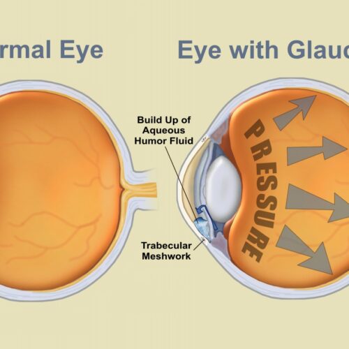 eyes_glaucoma